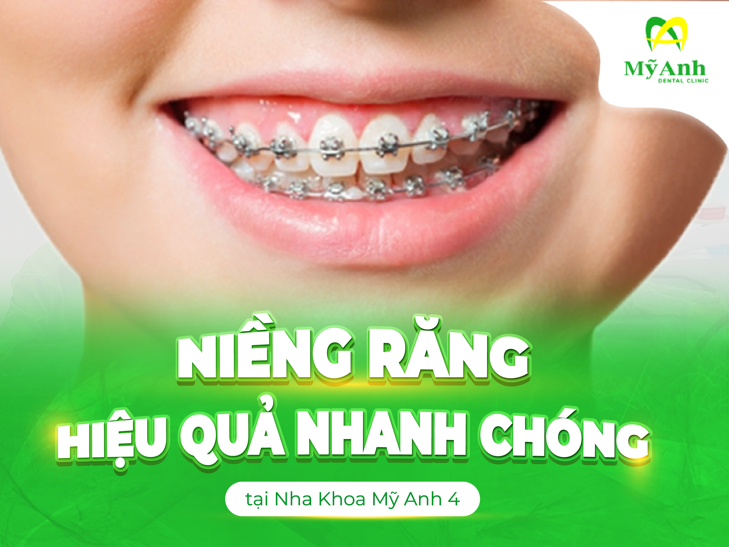 niềng răng ngay tại Tây Ninh