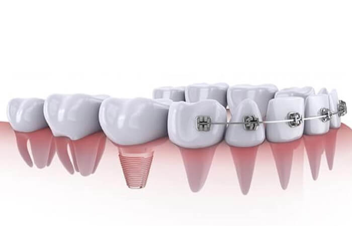 cắm trụ implant