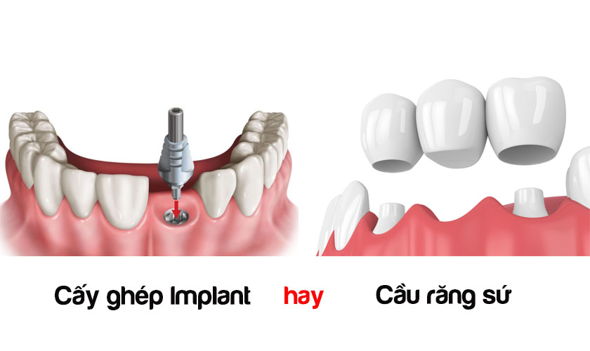 cấy ghép implant