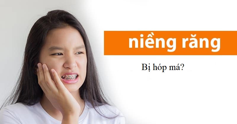 niềng răng